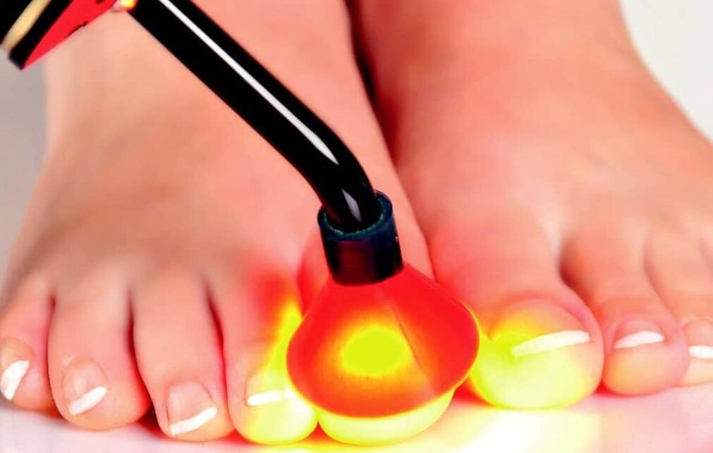 Küüneplaadi laserravi